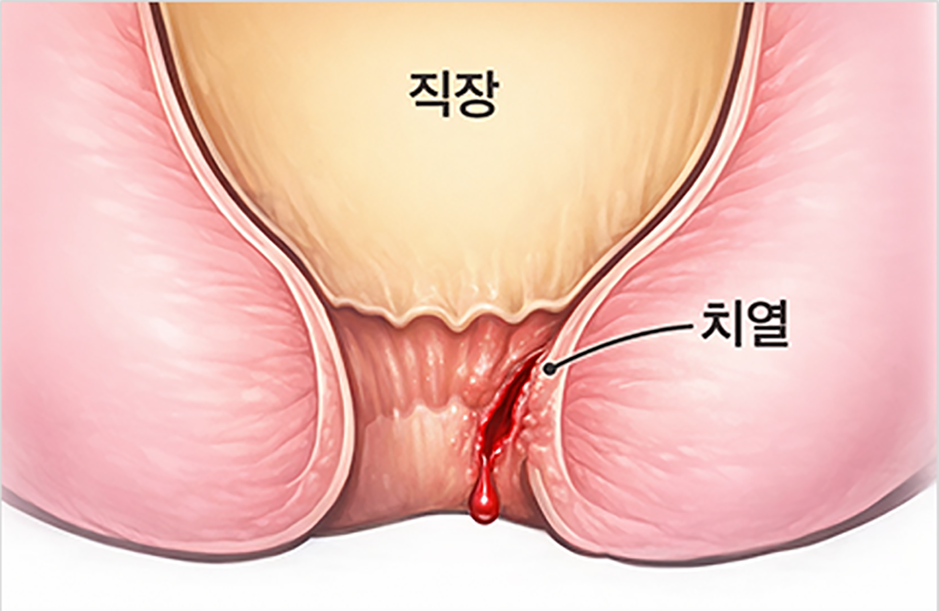 치열
