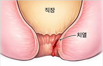 치열