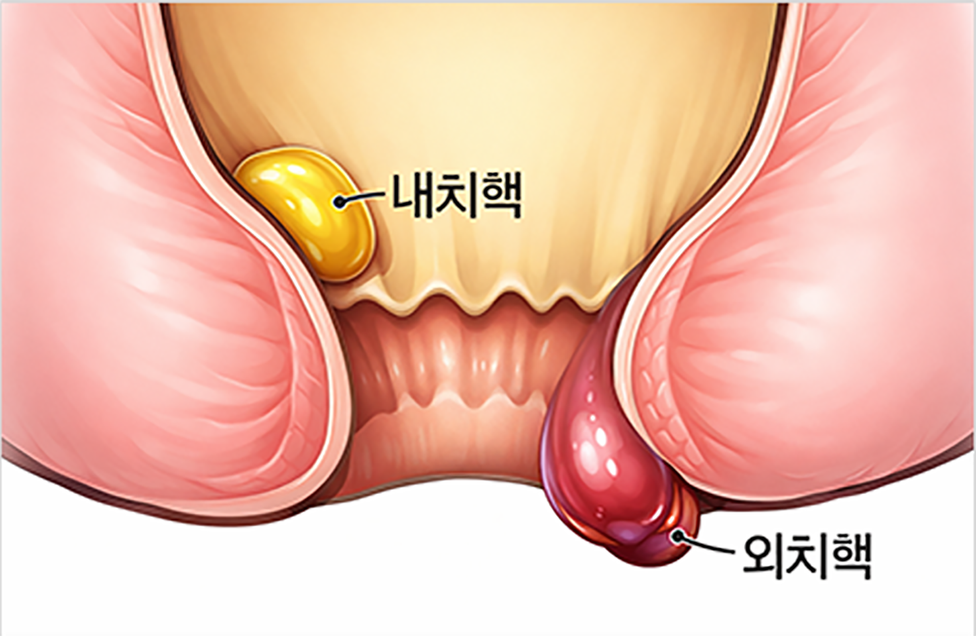 치질(치핵)