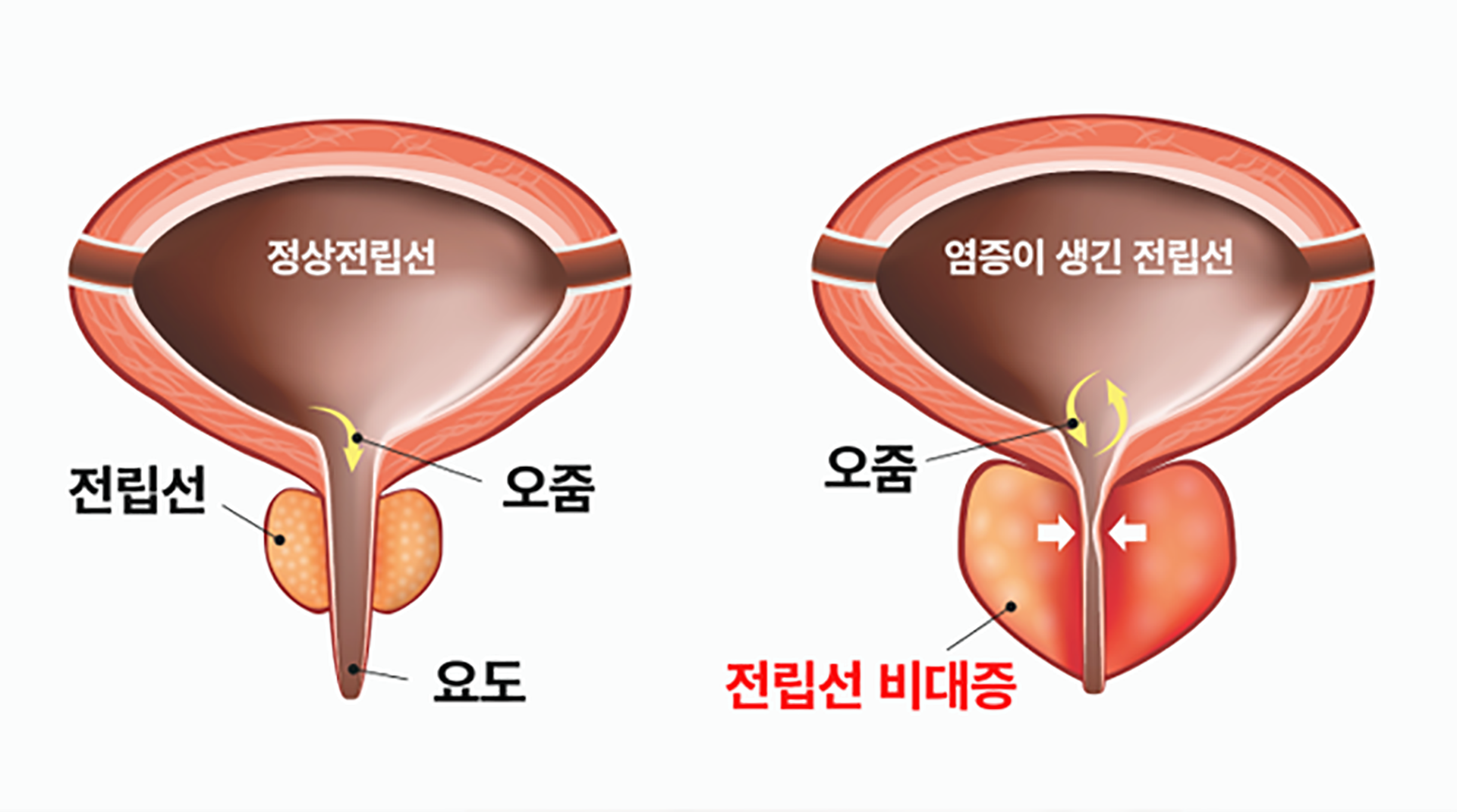 전립선 비대증 이미지
