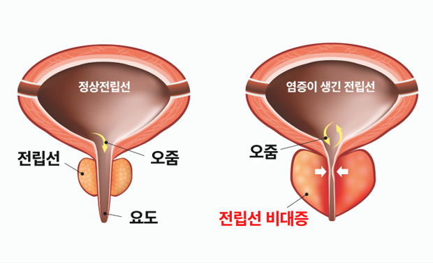 전립선 비대증 이미지