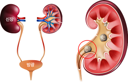 요로결석이란