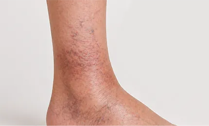 심부정맥 역류 동반형 다리 사진